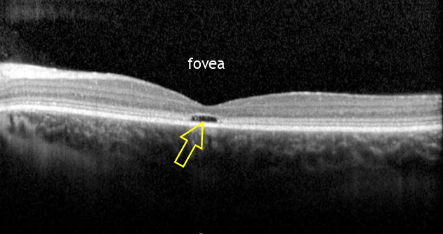Photography showing a part of the retina with the fovea. A dark patch is visible just at the fovea's location. A yellow arrow points to this dark patch.